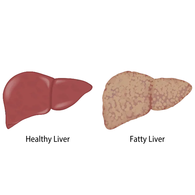 Ilustración anatómica del hígado humano mostrando infiltración grasa de los hepatocitos característica del MASLD (antes NAFLD)