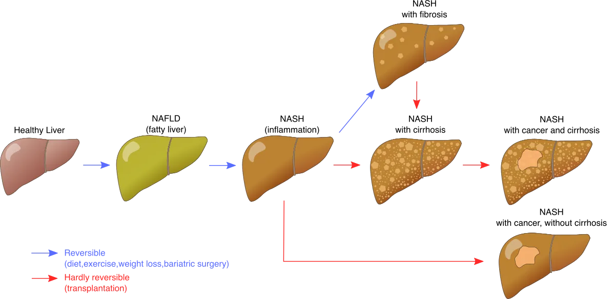 Diagrama de progresión que muestra las etapas de la enfermedad hepática: hígado sano, hígado graso, NASH, fibrosis y cirrosis